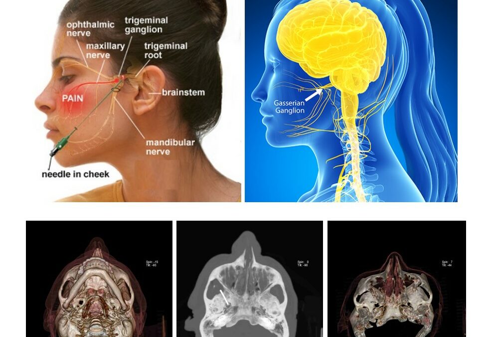 Trigeminal Sinir Ganglion