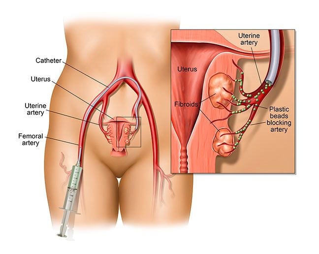 Uterin Fibroid veya Miyom Embolizasyonu